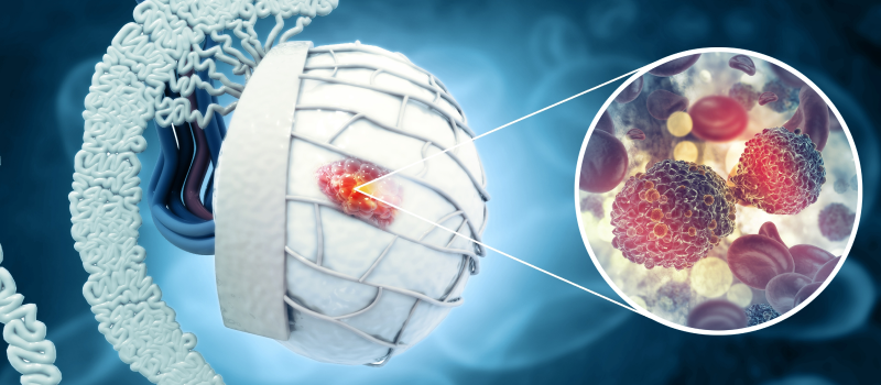 Testicular Cancer